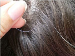 Premature-White-Hair-Tips-by-Dr-Khurram-Mushir